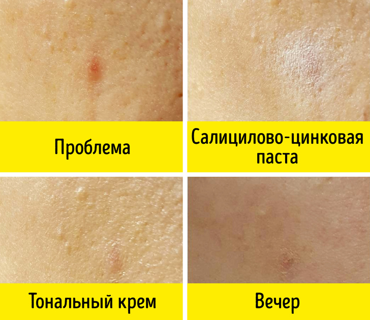 Саліцилової-цинкова паста - Бюджетні кошти з аптеки, які працюють не гірше дорогої косметики Салицилово-цинковая паста - Бюджетные средства из аптеки, не хуже дорогой косметики