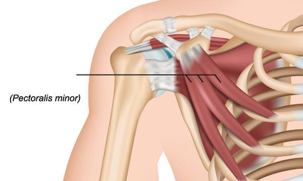 Малая грудная мышца – источник боли, о котором Вы не догадываетесь