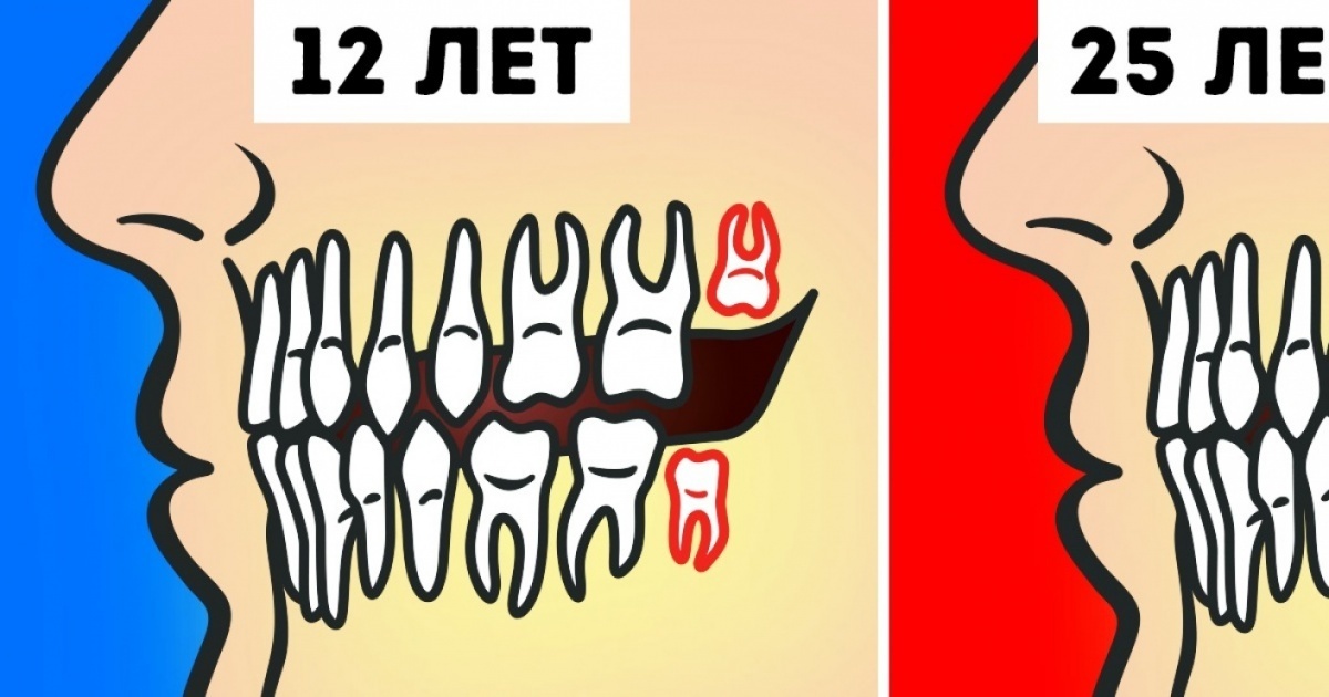 Чи потрібно насправді видаляти зуби мудрості? Удалять или нет зубы мудрости