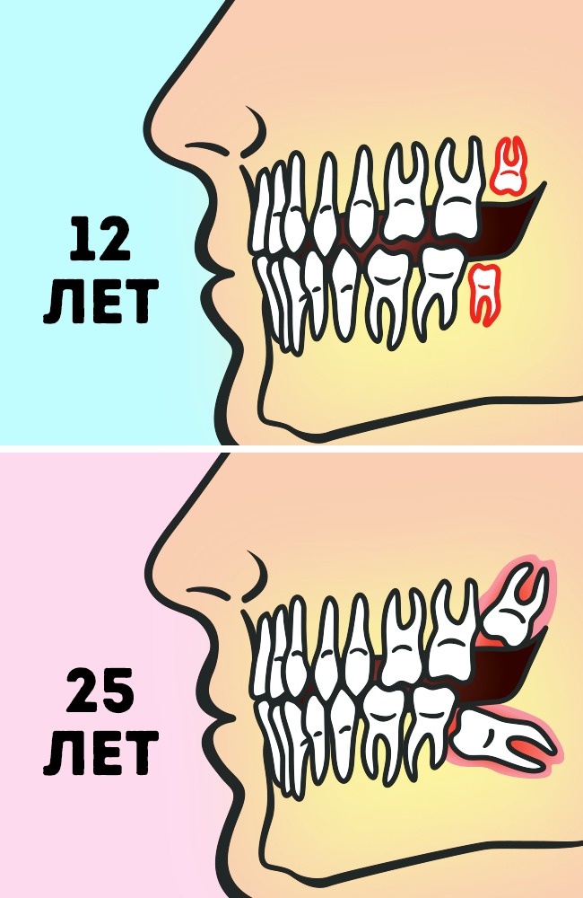 Чи потрібно насправді видаляти зуби мудрості? Удалять или нет зубы мудрости